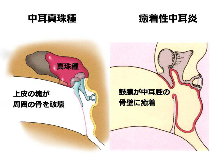 難治性中耳炎(癒着性中耳炎 中耳真珠腫)