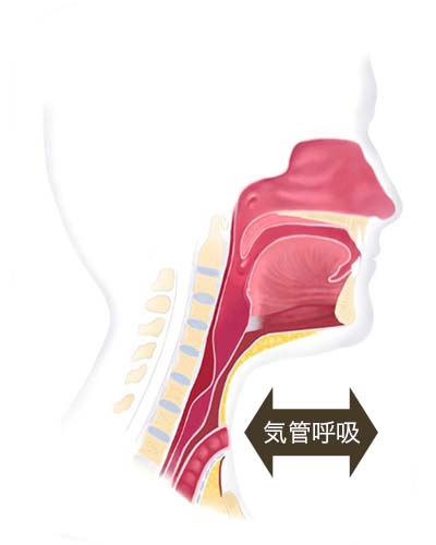 喉摘後:気管呼吸