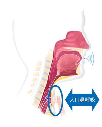 喉摘後+人工鼻:人工鼻呼吸