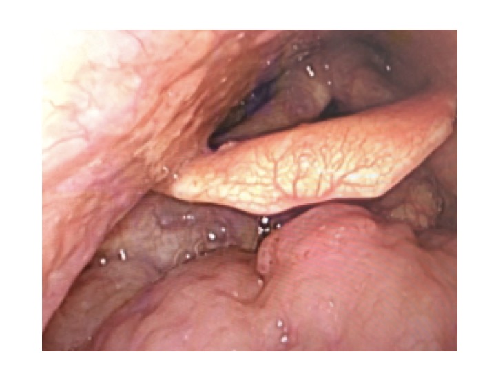 通常観察　舌根がん