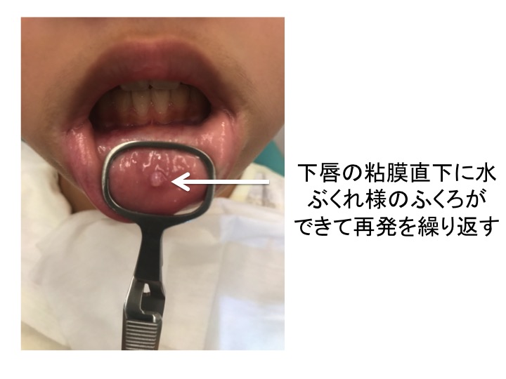 下口唇粘膜囊胞